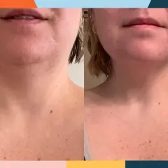 Before and after neck training: The left image shows a softer jawline and neck, while the right image displays a more defined jawline and smoother neck.